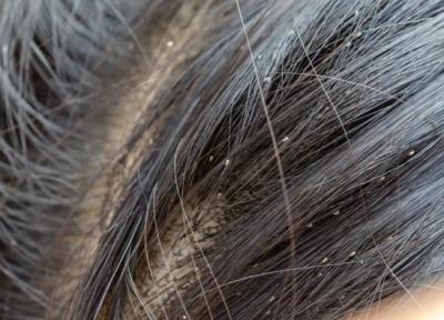 شپش سر یا پدیکولوز کپیتیس چطور تشخیص داده می گردد و درمان آن چیست؟